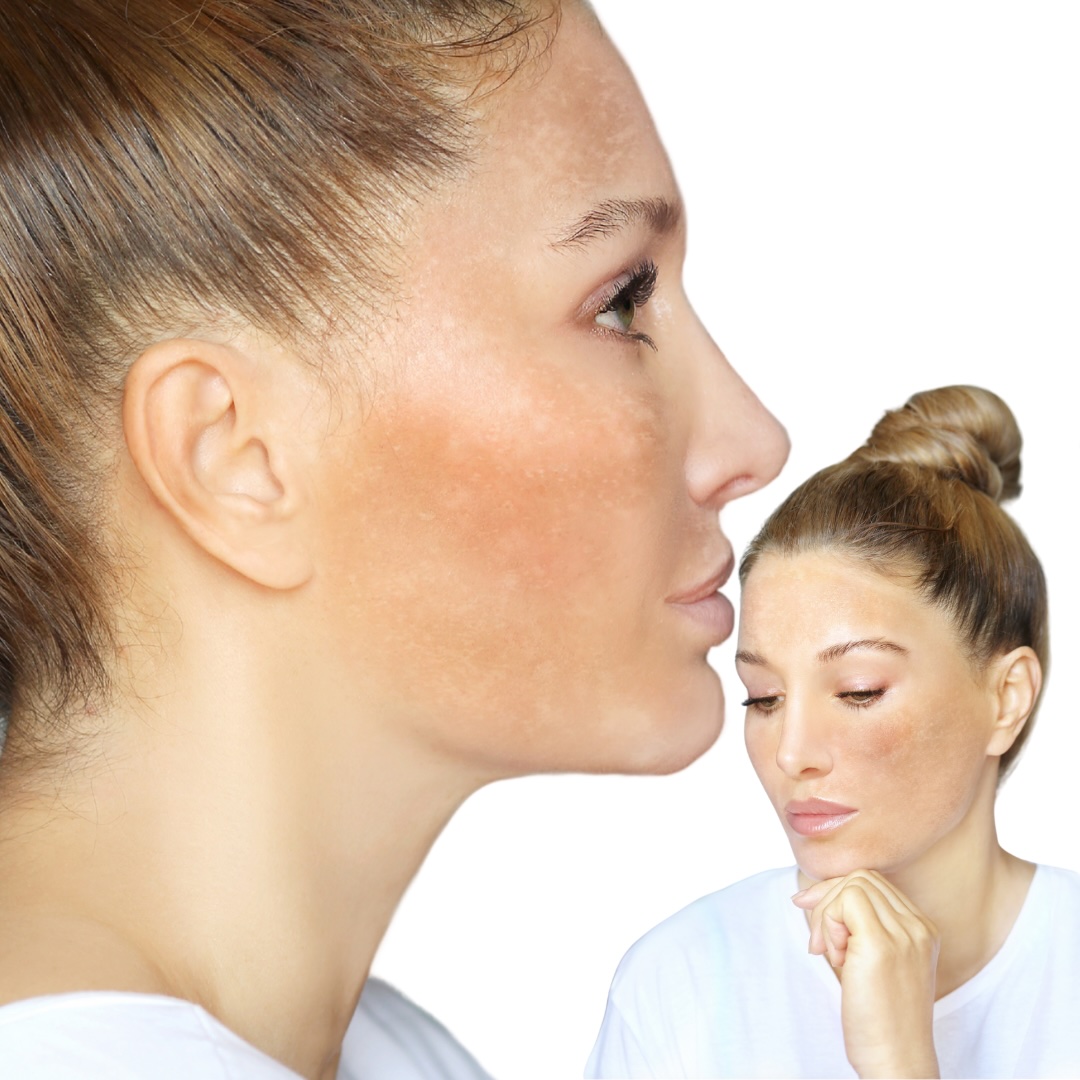 Hyperpigmentation